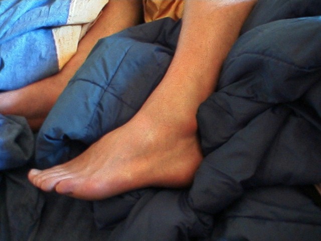 How serious hurt is the ankle ?