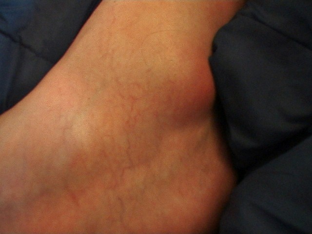 How serious hurt is the ankle ?